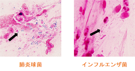 肺炎球菌、インフルエンザ菌