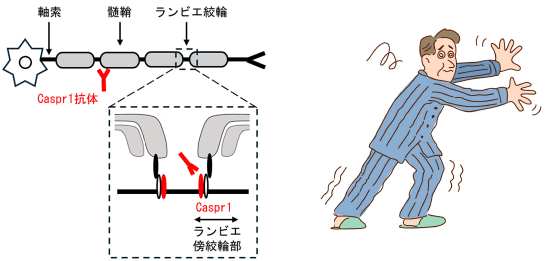 Clinical, Electrophysiologic, and Pathologic Features of Anti-Contactin-Associated Protein 1 Autoimmune Nodopathy, Noriko Isobe, Hidenori Ogata and Takumi Tashiro (Department of Neurology/Kyushu University Hospital)