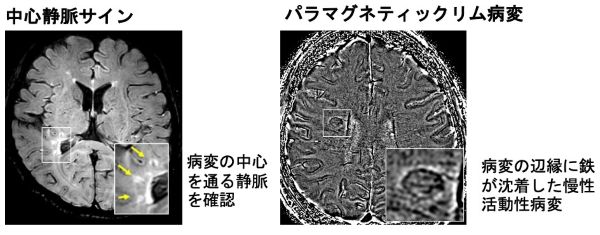 多発性硬化症の診断精度を向上させる新たなMRI画像指標 －組み合わせや若年層対象でさらに診断精度が向上、早期診断に期待－（神経内科学分野 磯部 紀子教授、松吉 彩乃大学院生、竹内 創大学院生、九州大学病院 脳神経内科 篠田 紘司助教）