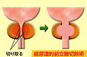 経尿道的前立腺切除術